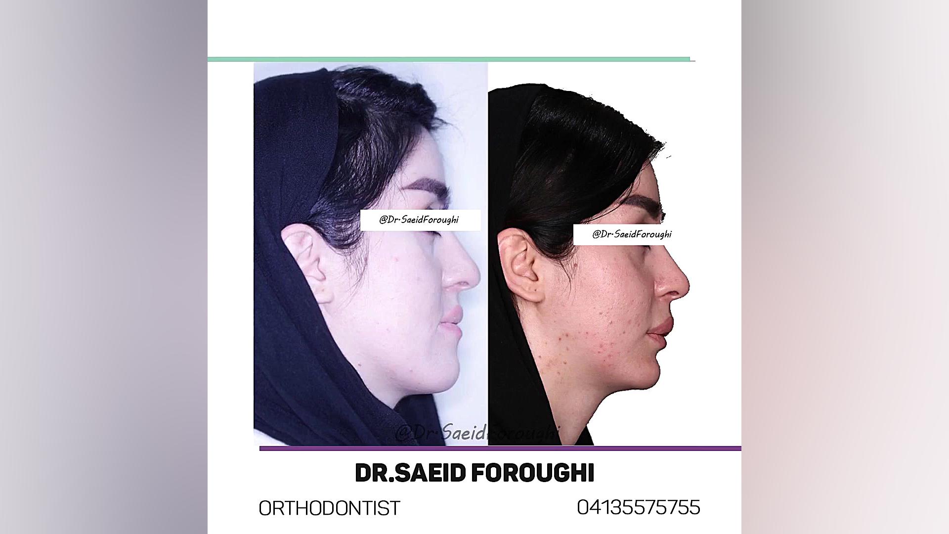 تأثیر درمان ترکیبی ارتودنسی و جراحی فک دکتر سعید فروغی متخصص ارتودنسی