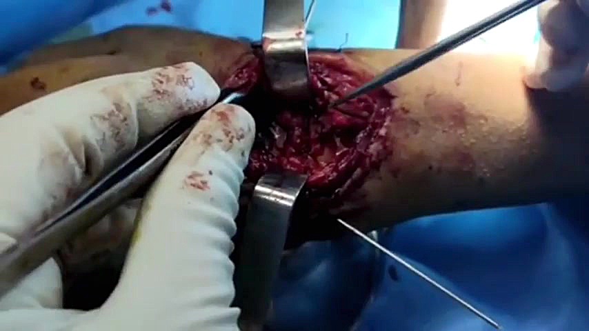 اپروچ جراحی در شکستگی در رفتگی ترانس اسکافویٔید پری لونیت جراحی زیبایی پلک