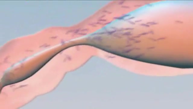 مالاریا [-www.zist-golestan.blogfa.com-] برداشتن خال