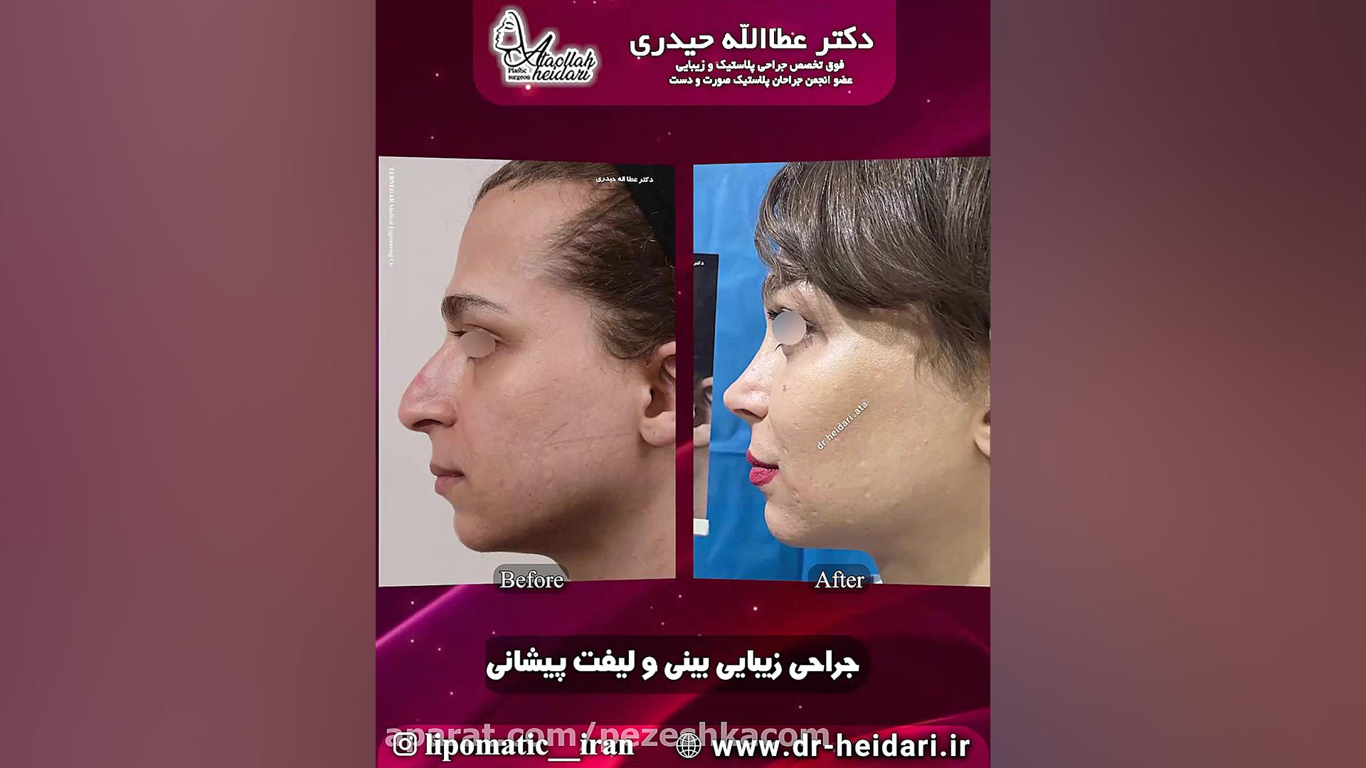 جراحی زیبایی بینی و لیفت پیشانی پزشکی فضاپویا