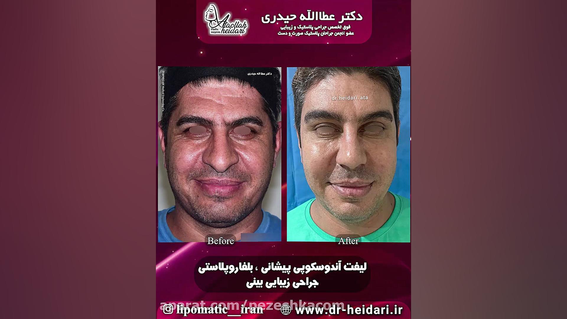 لیفت پیشانی توسط دکتر عطالله حیدری ChIP-Chip
