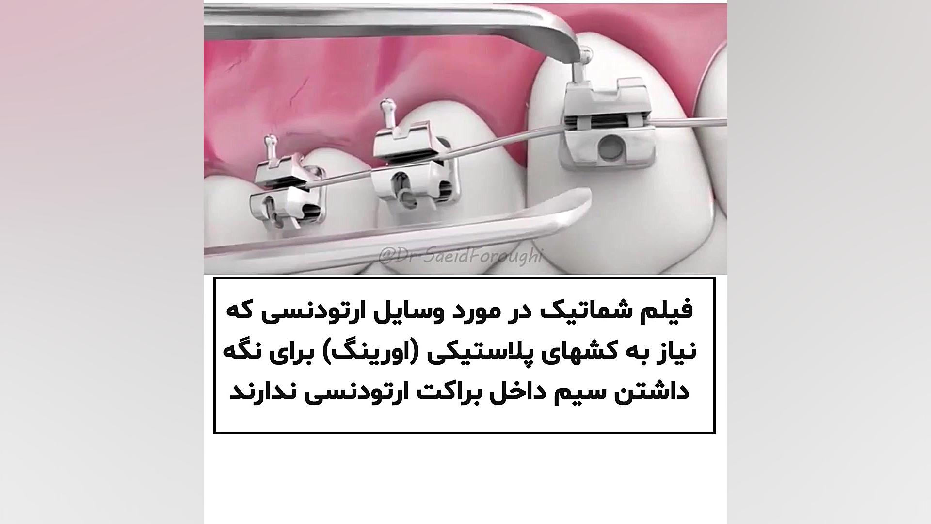 فیلم شماتیک در مورد وسایل ارتودنسی که نیاز به کشهای پلاستیکی (اورینگ) دکتر سعید فروغی متخصص ارتودنسی