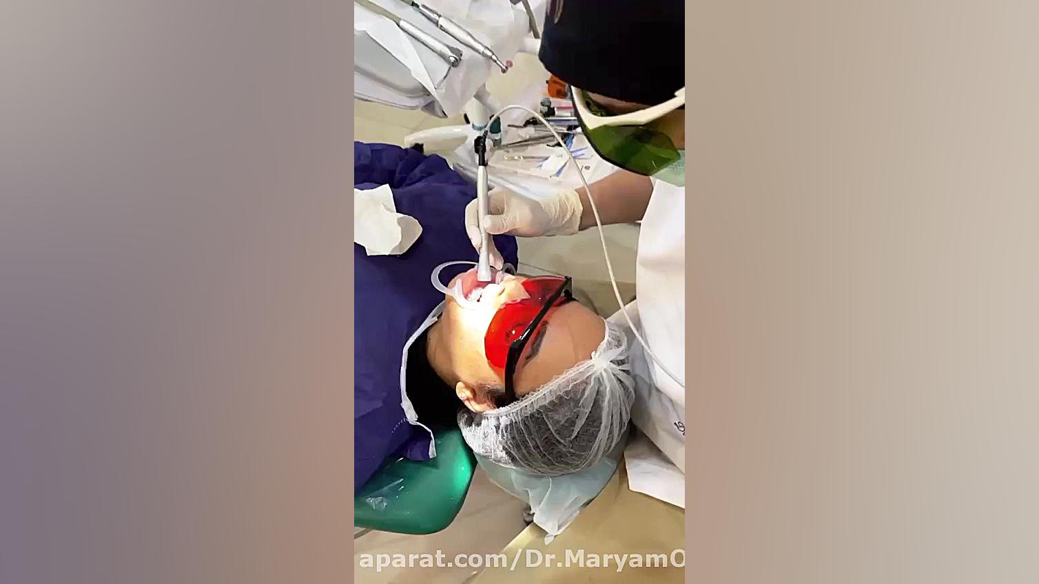 مراحل انجام بلیچینگ دندان(Teeth bleaching) اولتراسوند پرتابل جیبی