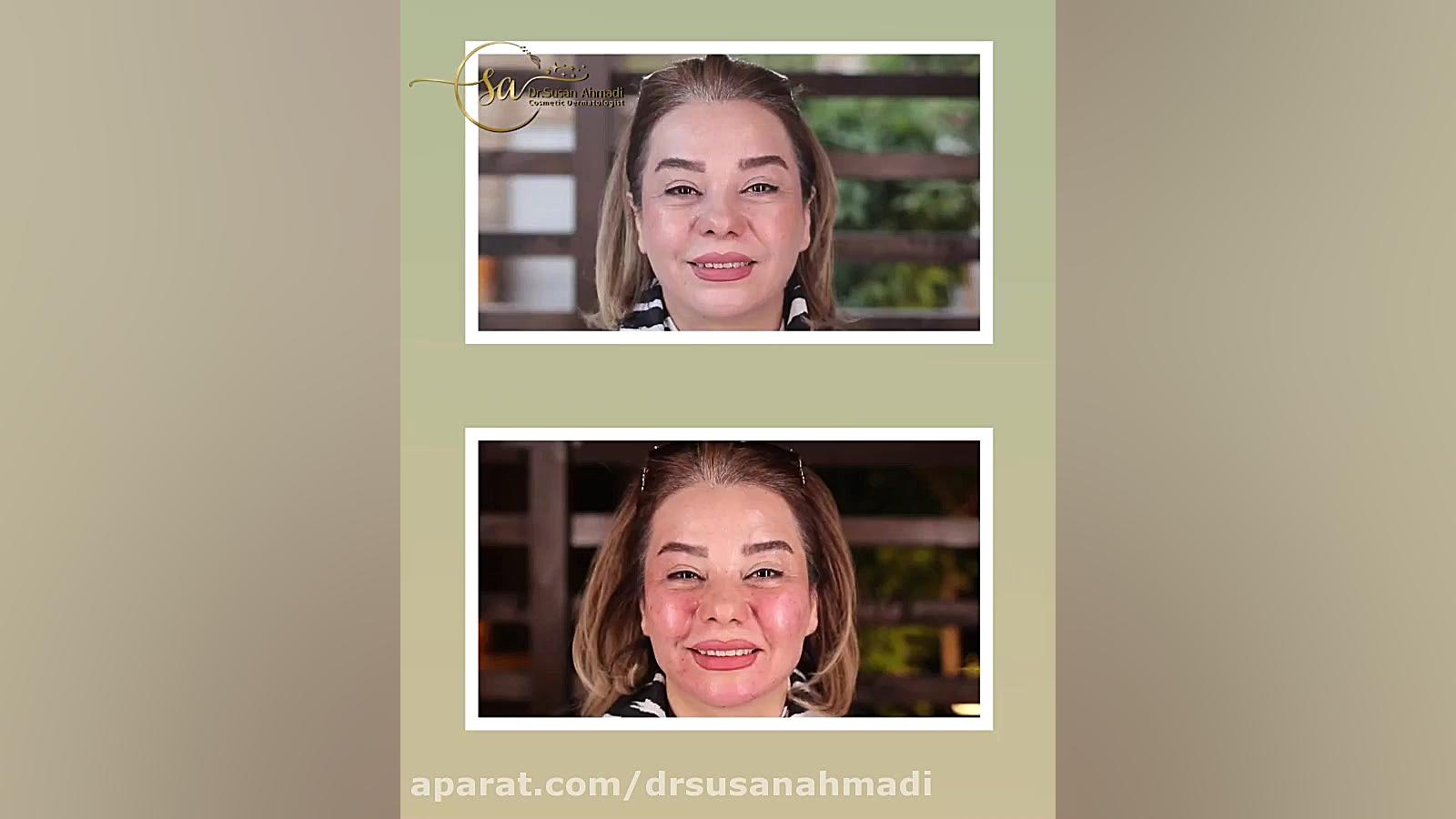 فیلم تزریق چربی صورت واقعی!! کلینیک دندانپزشکیایمونولوژی پیوند