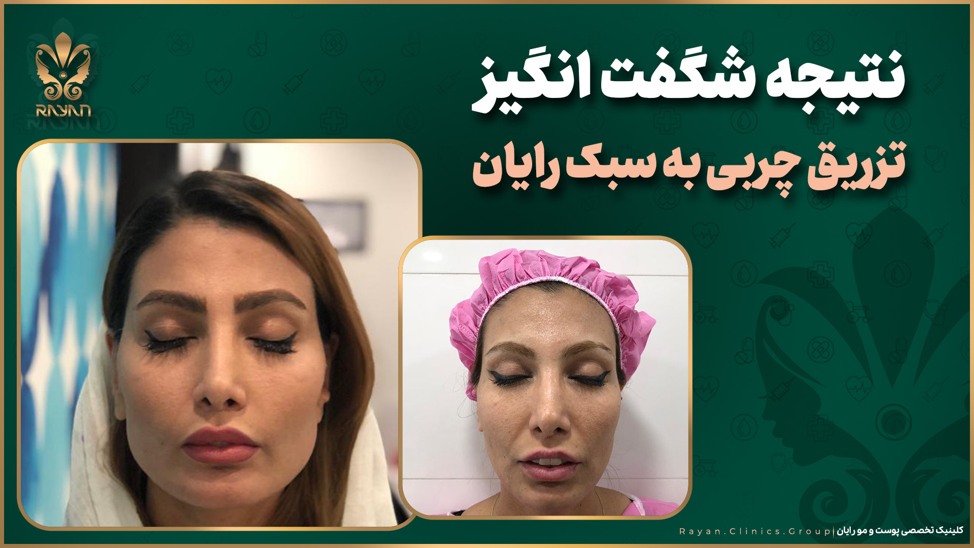 کلینیک های رایان مو | مقایسه قبل و بعد از تزریق چربی به سبک رویان جراحی زیبایی پلک