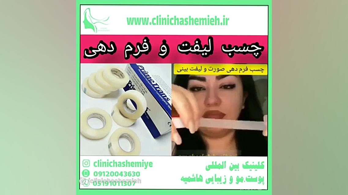 چسب لیفت بینی با نخ چیست؟ لمینت