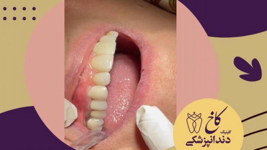 دقت ویژه در انتخاب رنگ روکش دندان کلینیک دندانپزشکی کاخ