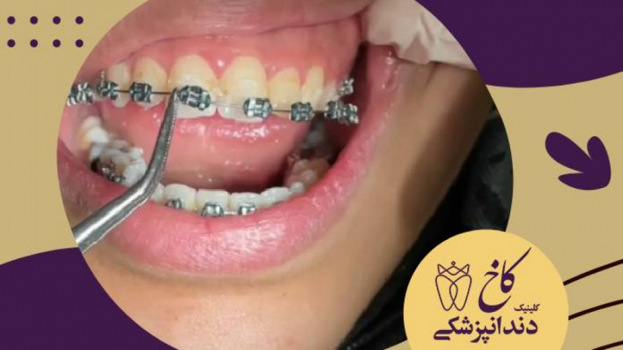 پایان خوشایند ارتودنسی کلینیک دندانپزشکی کاخ