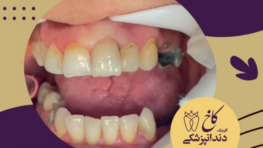 رنگ روکش مناسب با دندان های طبیعی بیمار کلینیک دندانپزشکی کاخ