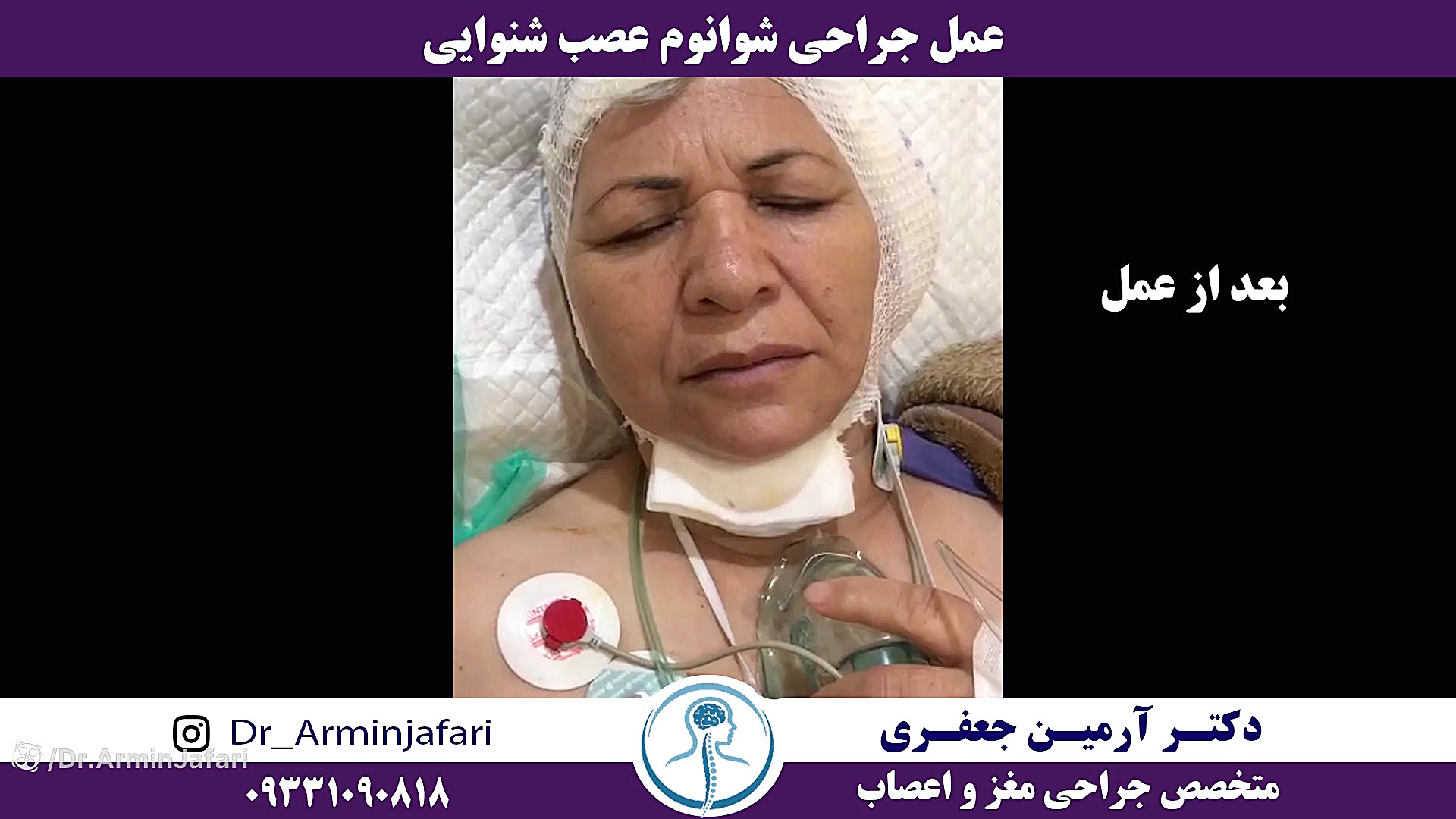 عمل جراحی شوانوم عصب شنوایی شلپ شلپ
