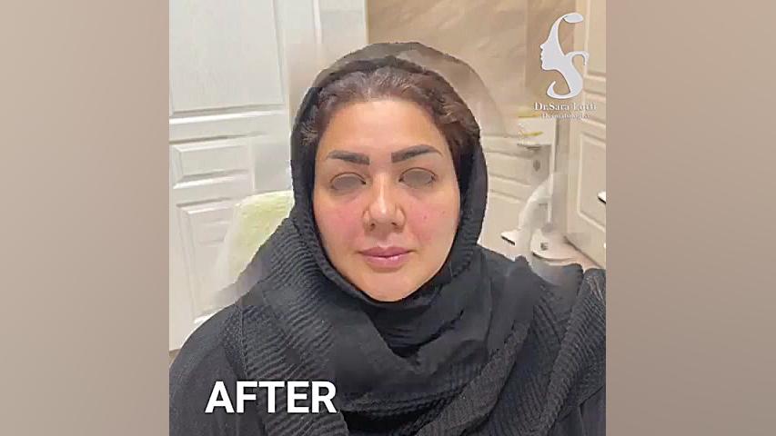 فیلر زیر چشم و خط لب و پیشانی دکتر سار ا لطفی