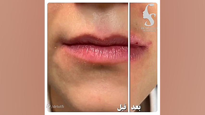تزریق ژل لب دکتر سار ا لطفی