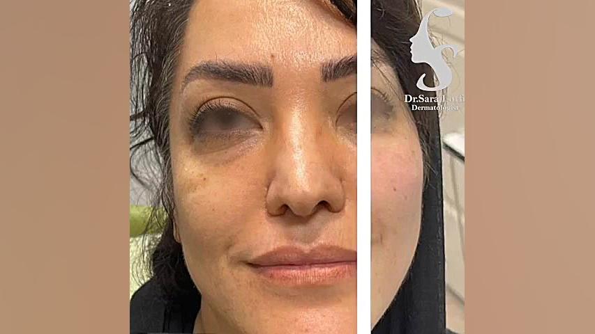 تزریق فیلر زیر چشم، خط خنده و گونه دکتر سار ا لطفی