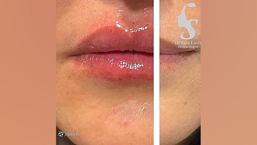 تزریق فیلر لب دکتر سار ا لطفی