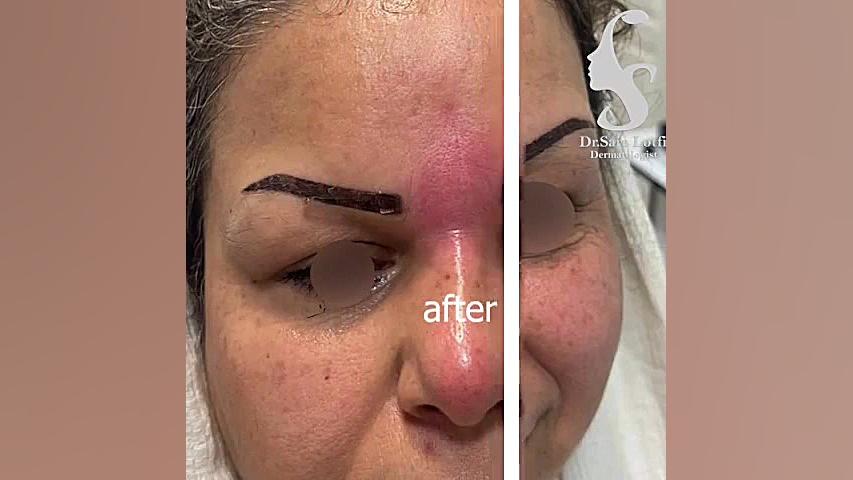 اصلاح فرورفتگی بینی و خود بینی دکتر سار ا لطفی