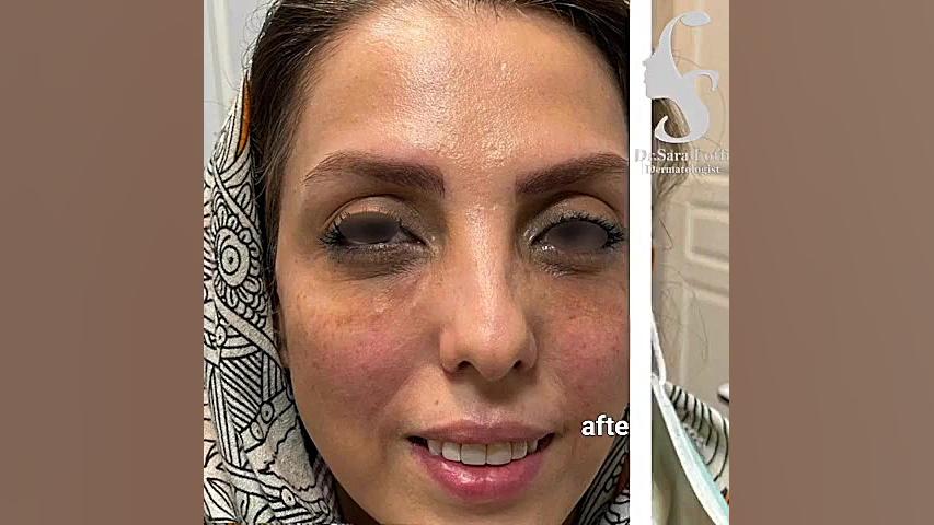 تزریق فیلر در نقاط مختلف صورت دکتر سار ا لطفی
