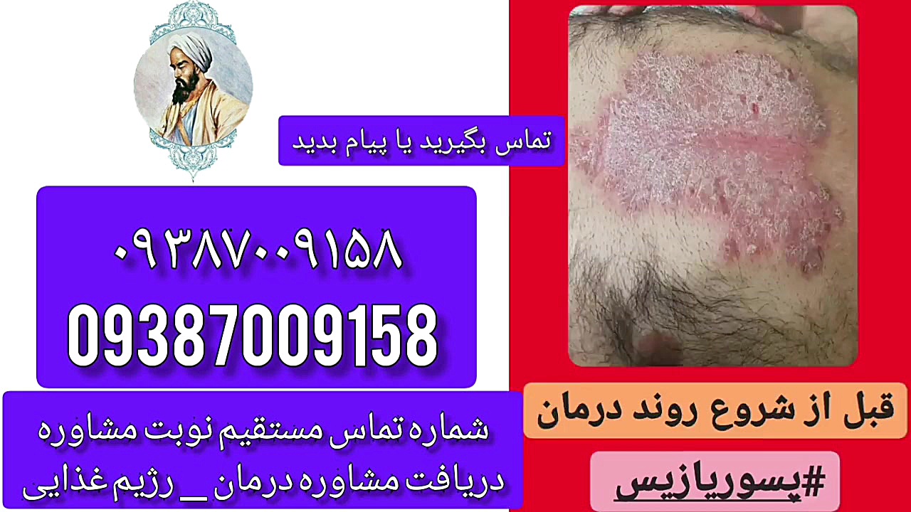 بیش از 500 نمونه درمان شده بیماری پوستی پسوریازیس psoriasis برداشتن توده