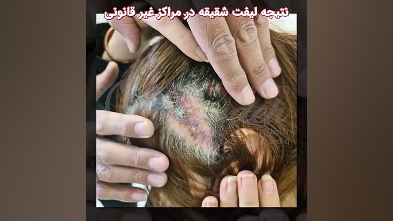 عاقبت لیفت شقیقه در مراکز غیرقانونی دکتر مریم نوکنده