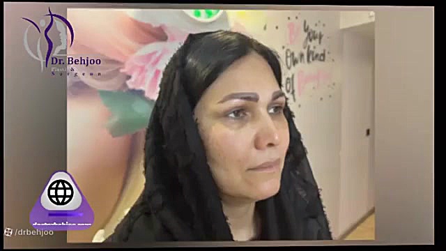 یک هفته بعد از بلفاروپلاستی پلک بالا دکتر شاهین بهجو - فوق تخصص جراحی پلاستیک