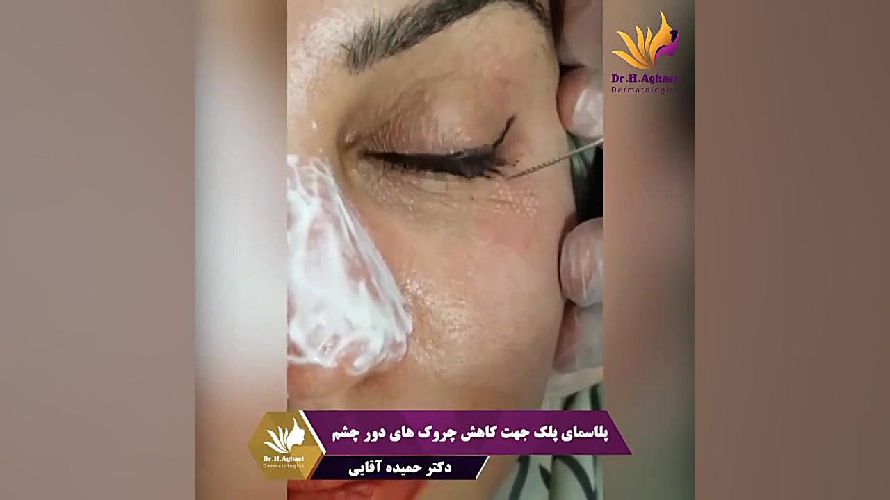 پلاسمای پلک جهت کاهش چروک های دور چشم دکتر حمیده آقایی