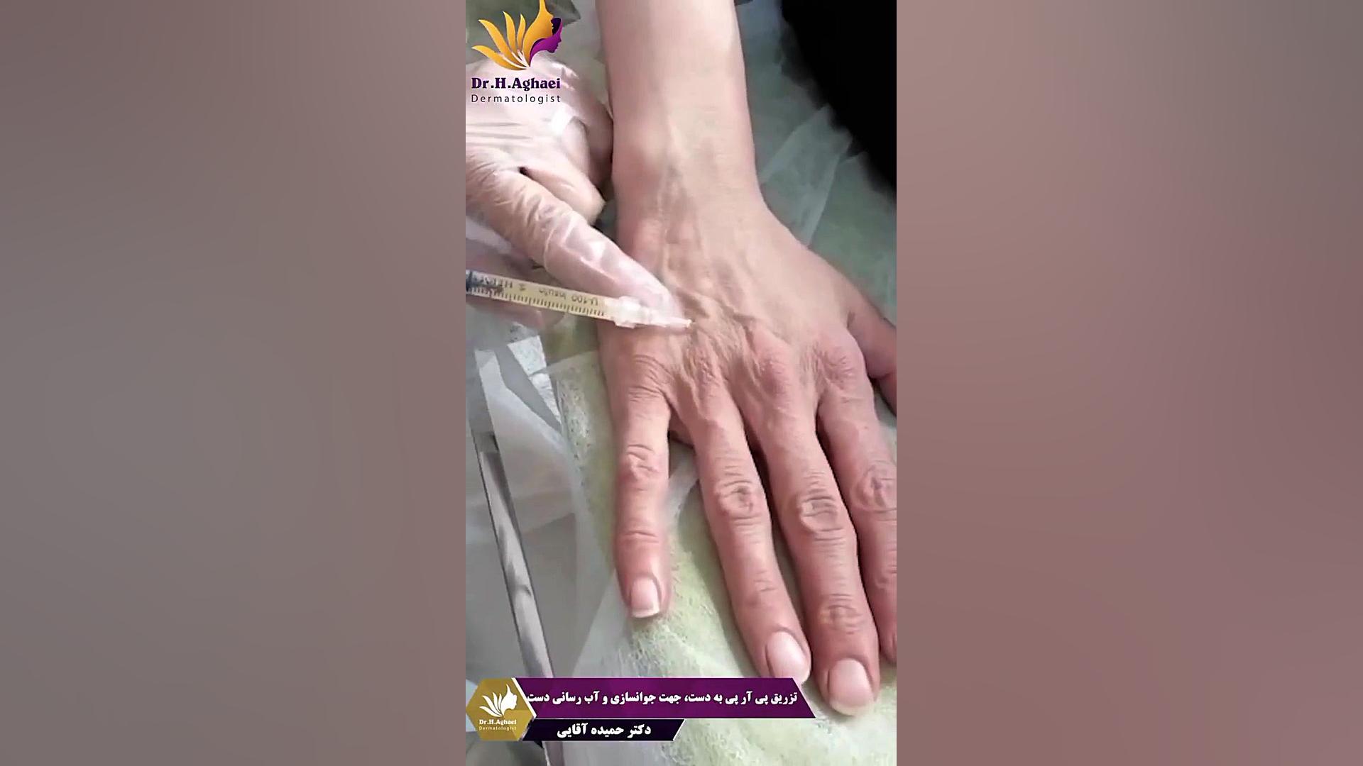 جوانسازی پوست دست با پی آر پی دکتر حمیده آقایی