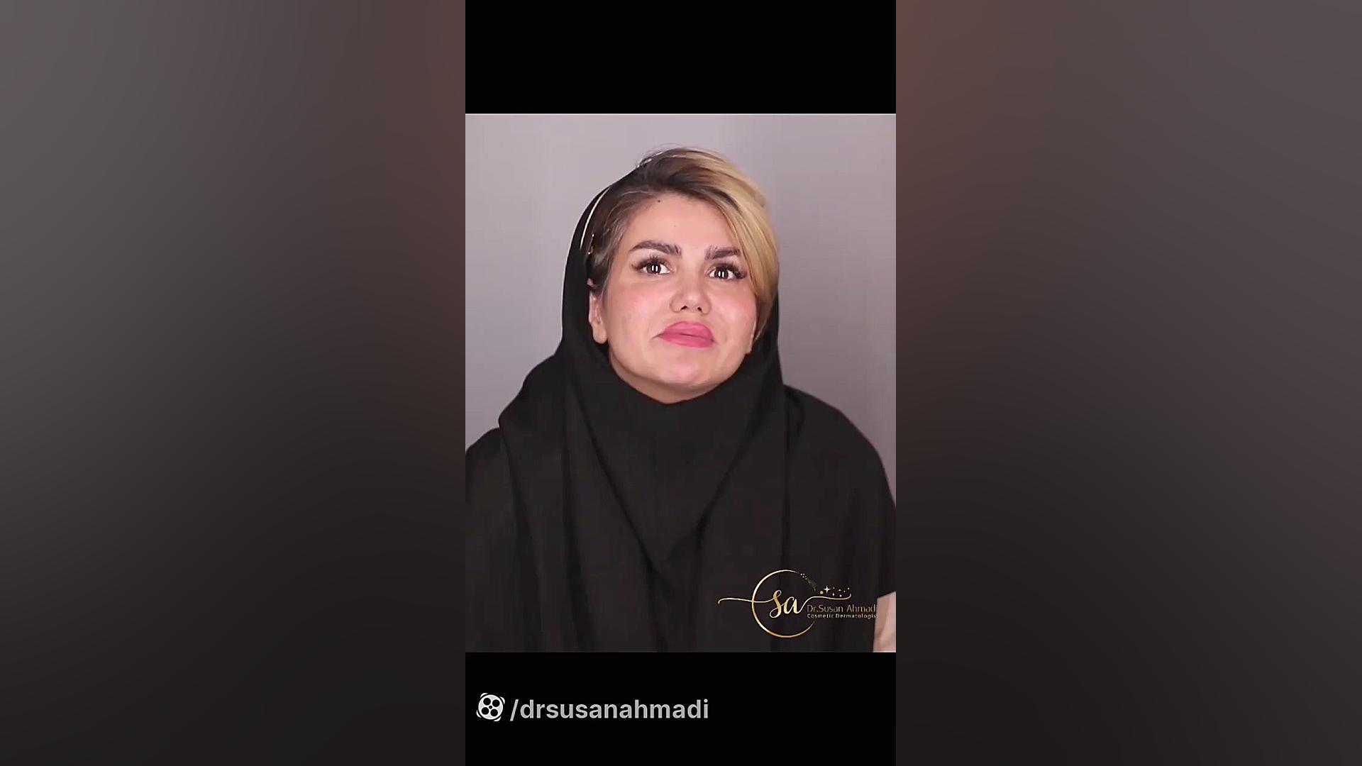 فیلم رضایت تزریق بوتاکس و فیلر دکتر سوسن احمدی پیر شهید