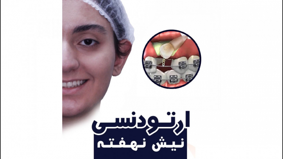 ارتودنسی نیش نهفته بدون کشیدن دندان | دکتر داودیان ایربسارتان