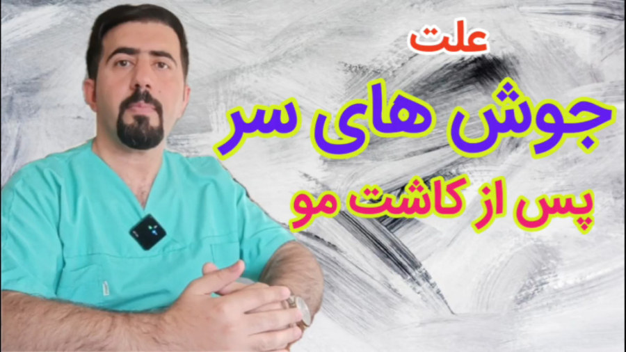 علت جوش های سر بعد از کاشت مو فرمانزوماب