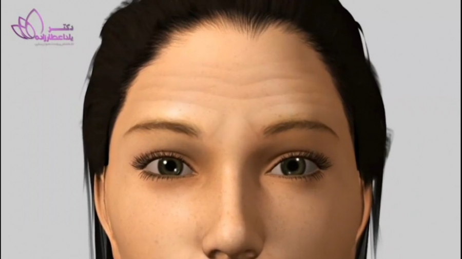 انیمیشن تزریق بوتاکس به پیشانی Organoid Viability Test