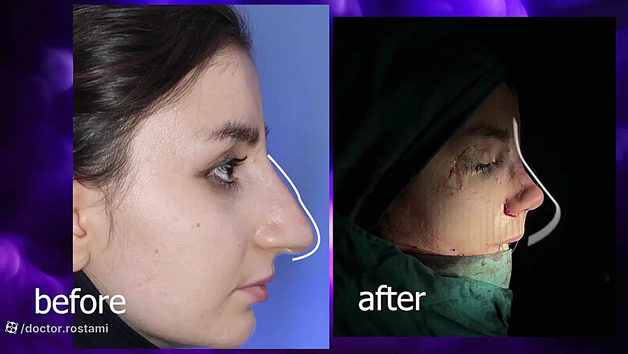 عمل زیبایی بینی پتوز دوطرفه