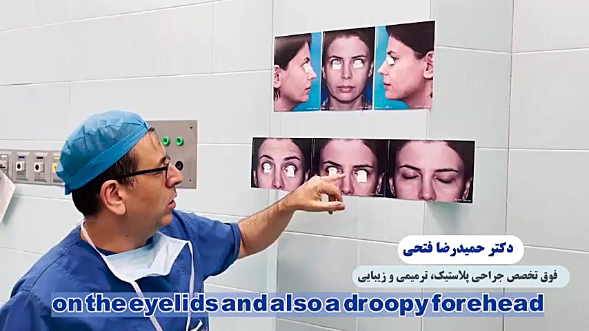 لیفت پیشانی به همراه جراحی زیبایی پلک لیفت ابرو