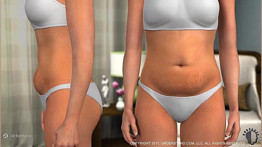 فیلم جراحی ابدومینوپلاستی به زبانی ساده دکتر شاهین بهجو - فوق تخصص جراحی پلاستیک