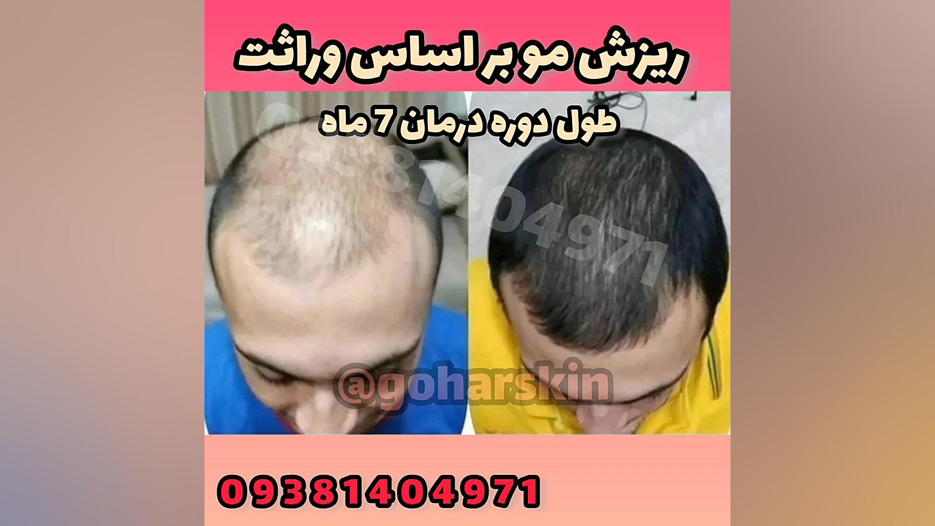 درمان ریزش مو ارثی ایمونولوژی محاسباتی