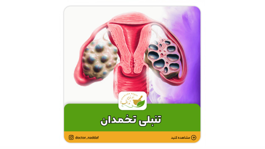 تنبلی تخمدان از موارد شایع در زنان