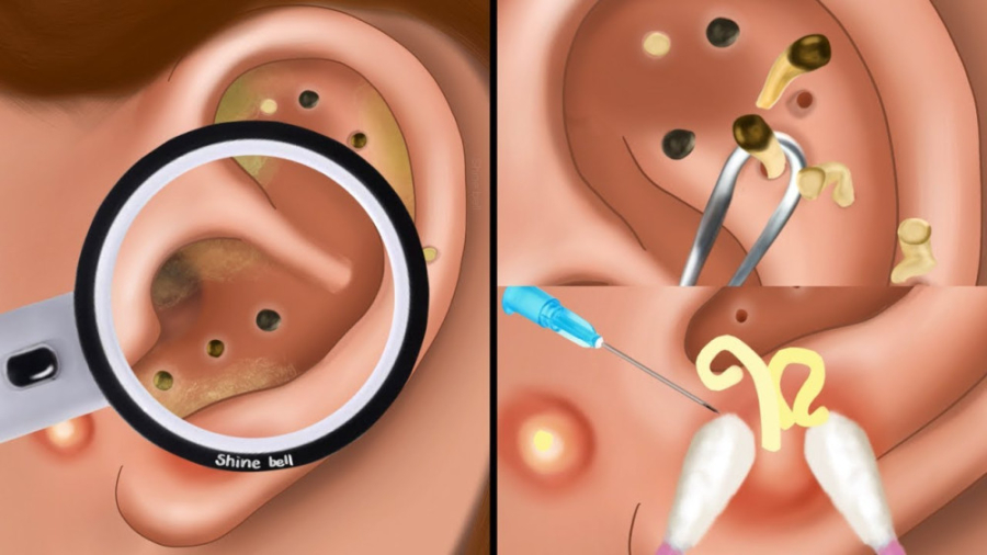 اسمر چندش و ریلکس ASMR »» خارج کردن جوش از روی گوش زیبایی پوست