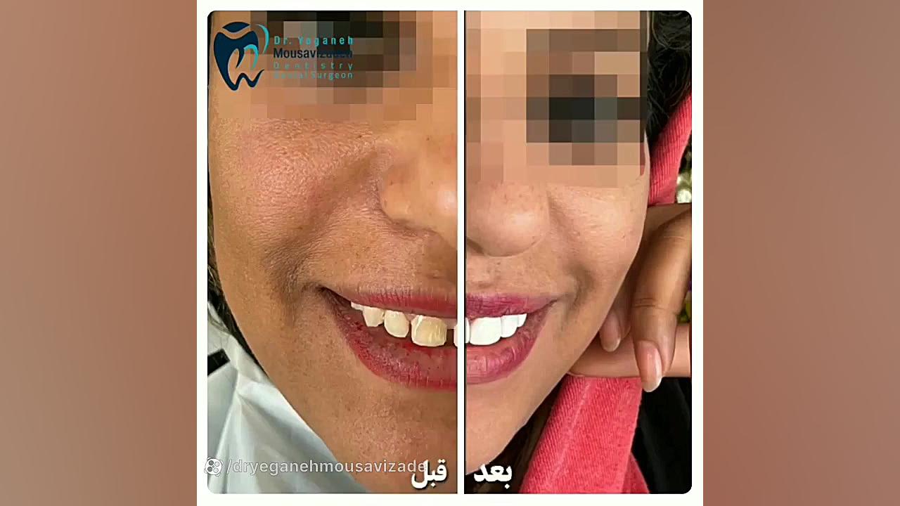 طرح لبخند زیبا با اصلاح فاصله بین دندان ها بیماری سندروم آلاژیل