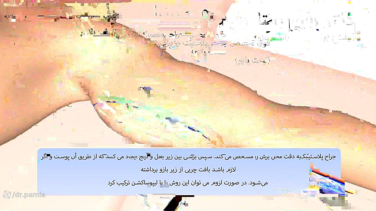 عمل لیفت بازو چطور انجام میشه؟ دکتر رفیع پرنیا فوق تخصص پلاستیک