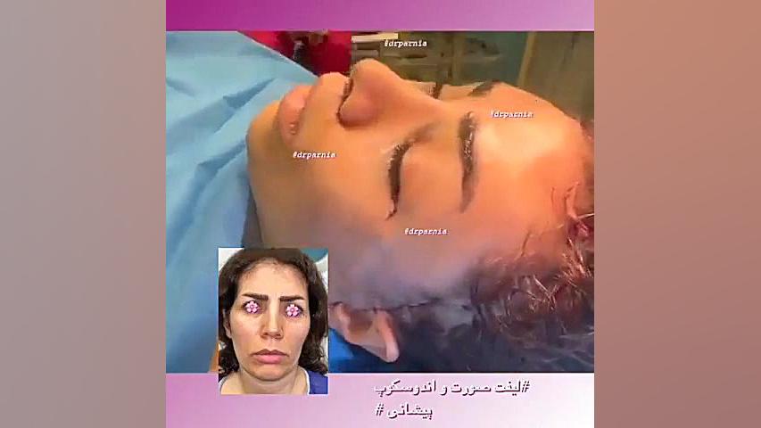 ليفت صورت و اندوسكوپ پيشاني دکتر رفیع پرنیا فوق تخصص پلاستیک