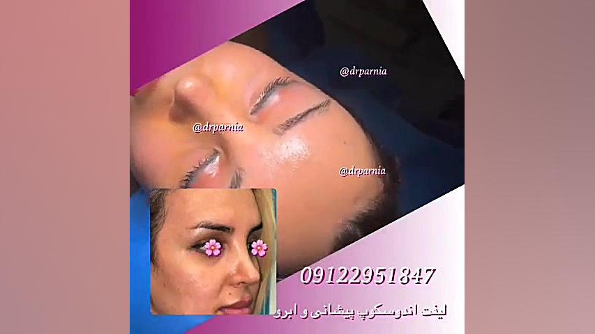 جراحی لیفت آندوسکوپیک پیشانی و ابرو دکتر رفیع پرنیا فوق تخصص پلاستیک