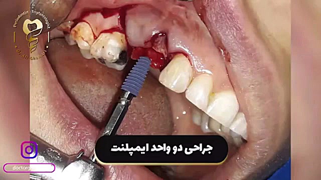 ️جراحی ۲ واحد ایمپلنت ️ دکتر علی قمری - متخصص جراحی لثه و ایمپلنت