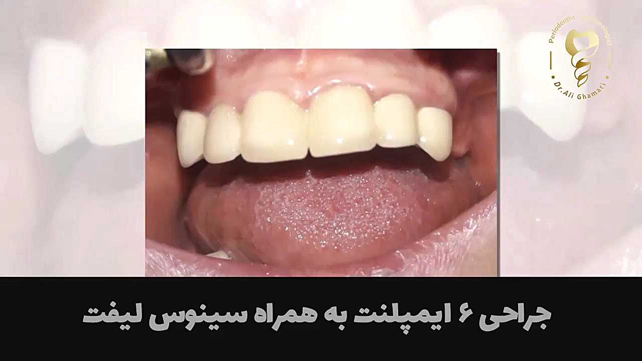 جراحی ۶ ایمپلنت به همراه سینوس لیفت دکتر علی قمری - متخصص جراحی لثه و ایمپلنت