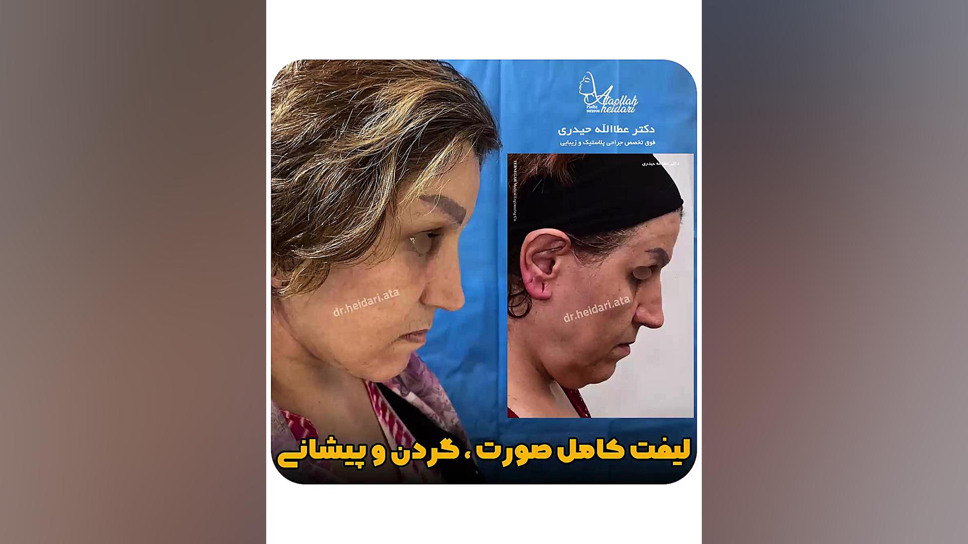 لیفت کامل صورت ، گردن و پیشانی لیپوماتیک