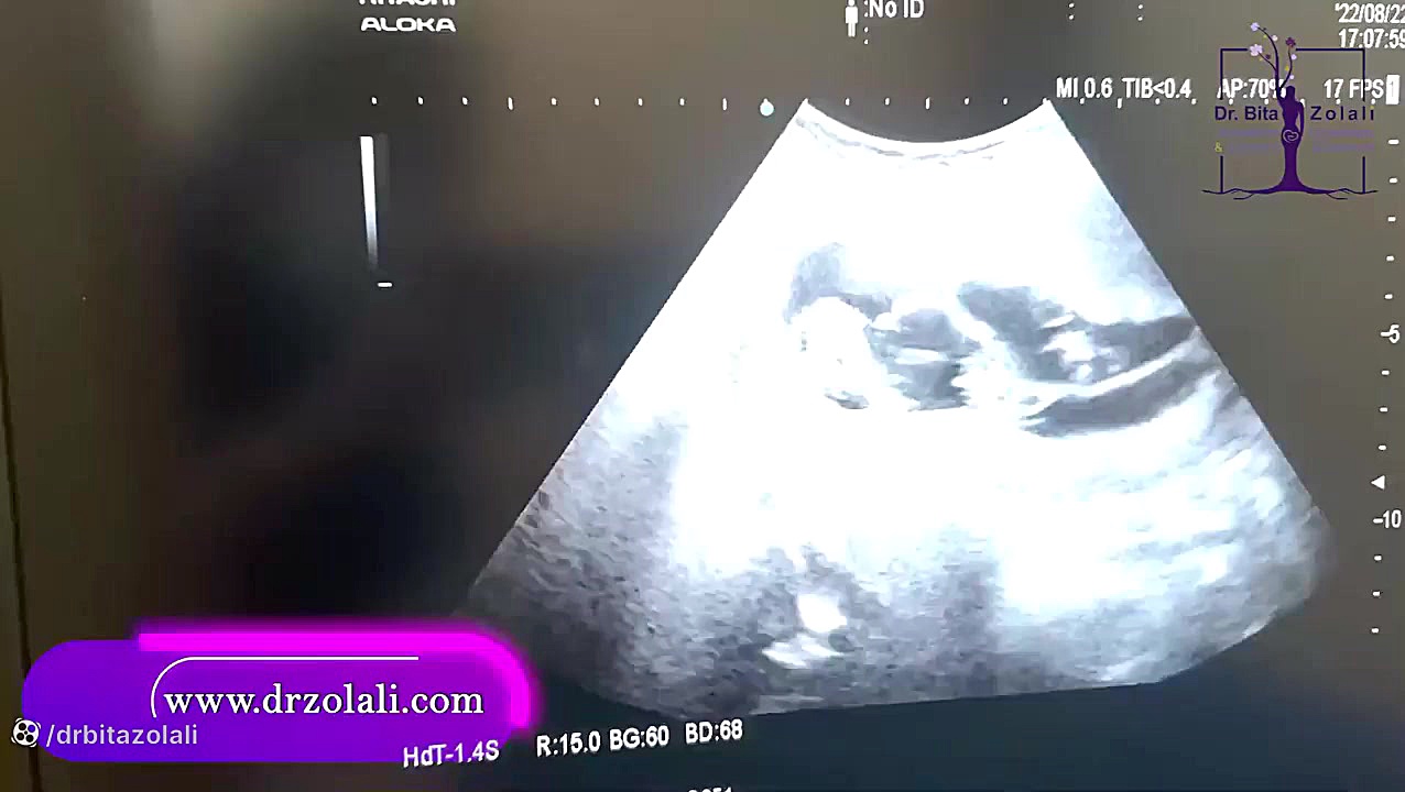 سونوگرافی 4 قلو ها ویدیوی وایرال