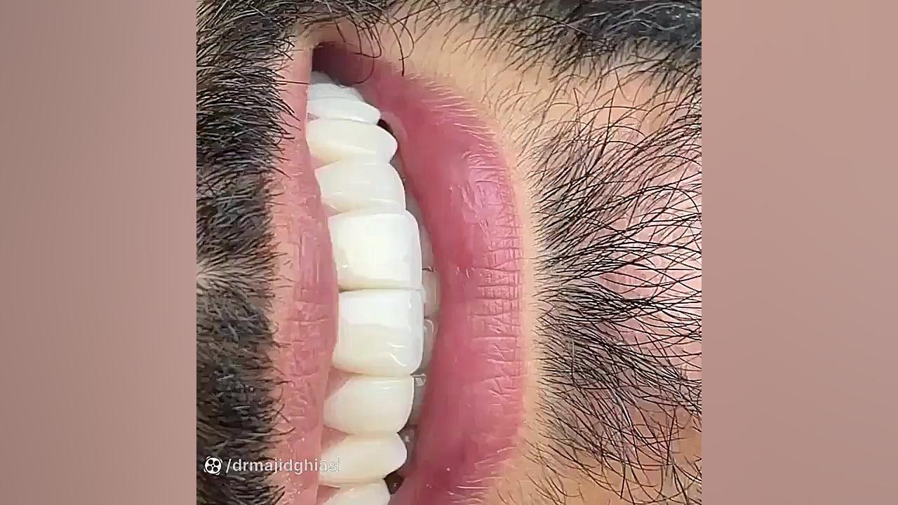 ترمیم پوسیدگی دندان جرمگیری