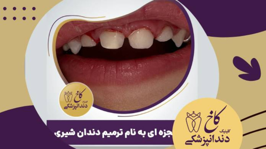 بریم یک قبل و بعد از دندان های شیری یک بیمار کوچولو ببینیم کلینیک دندانپزشکی کاخ