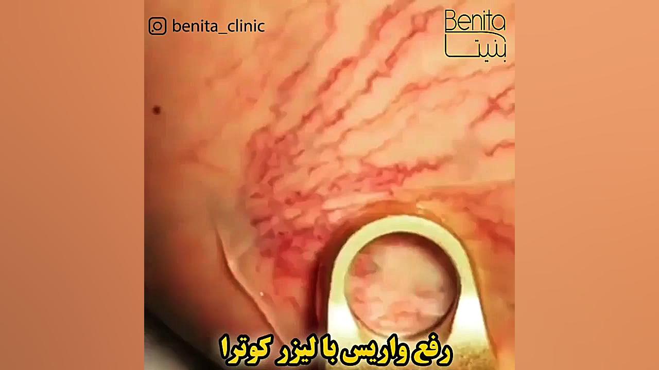 لیزر مو های زائد در آقایان جراحی لثه