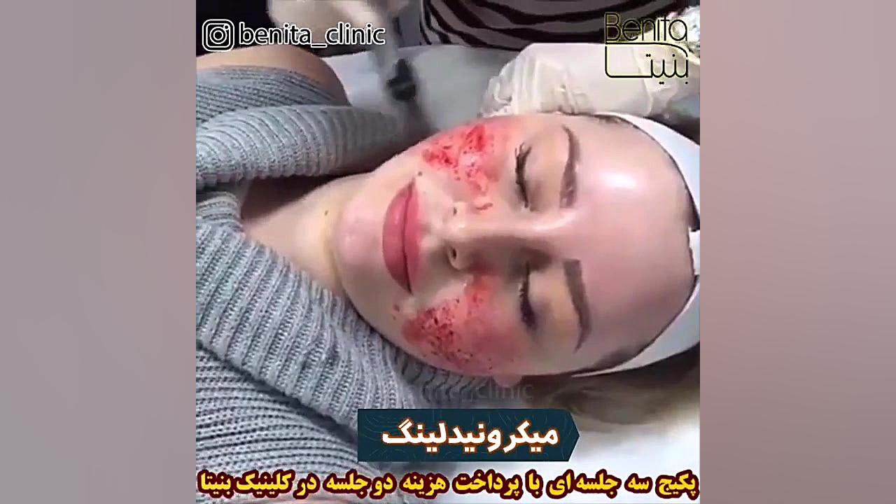 میکرونیدلینگ ترمیم دندان