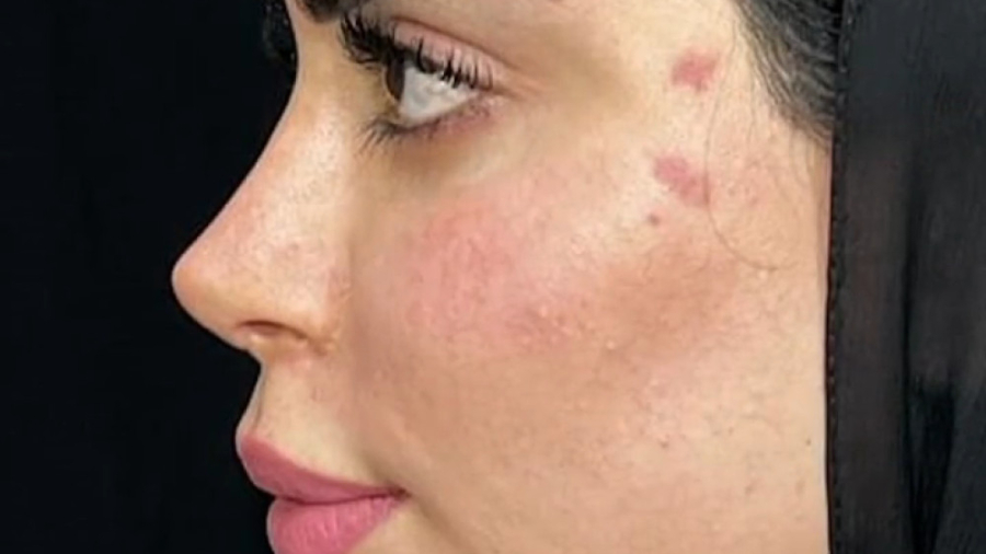 نمونه کار جراحی بینی ترمیمی | دکتر محمد علی حسینی کلینیک زیبایی