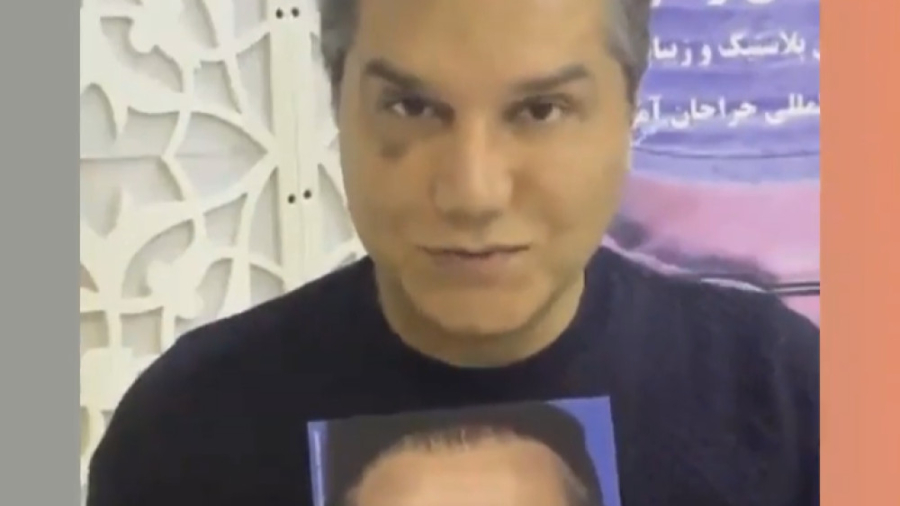 عمل ترمیمی بینی،بلفاروپلاستی پلک بالا و پایین،قطع عصب اخم و تزریق چربی به پیشانی مایکل جردن