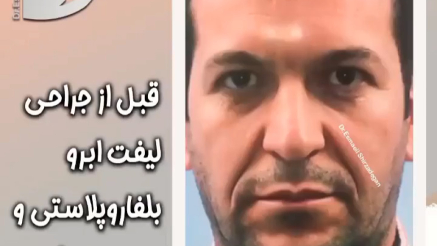 قبل از جراحی لیفت ابرو ، بلفاروپلاستی و تزریق نانوفت دکتر اسماعیل شیرزادگان